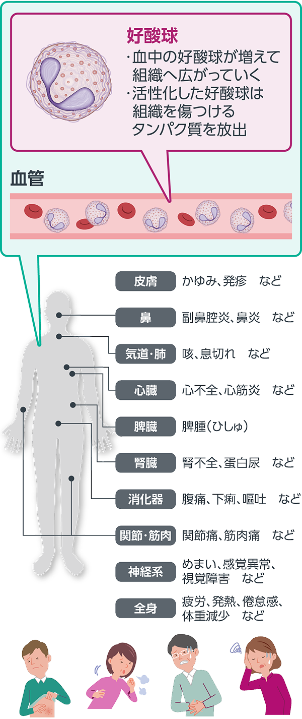 画像 HESと好酸球