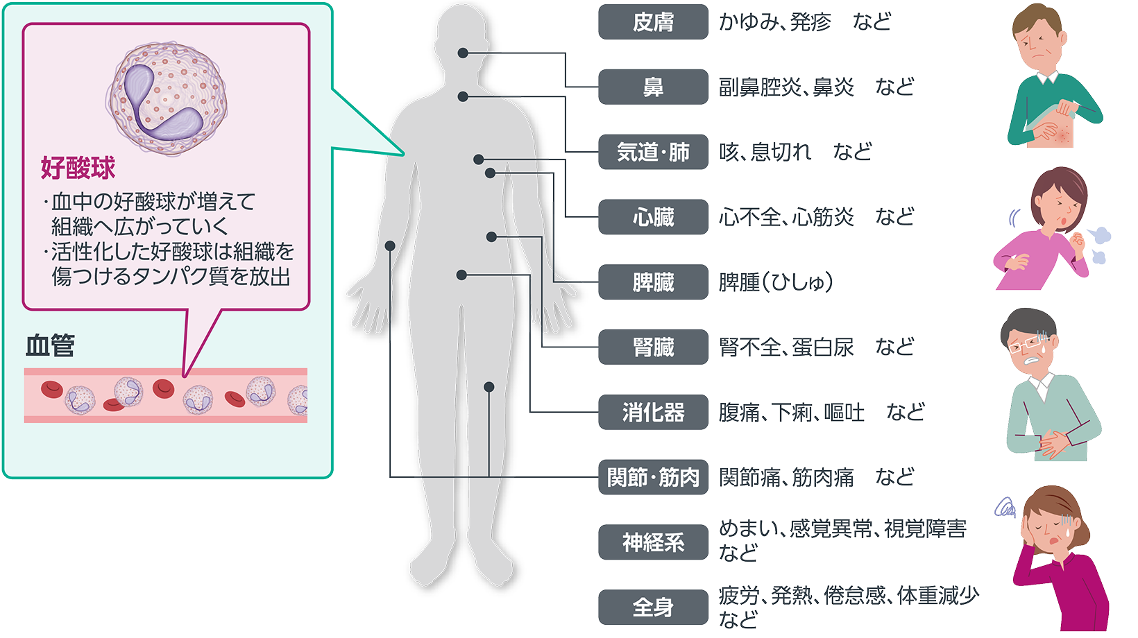 画像 HESと好酸球